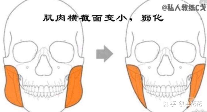 (百度上找的咬肌缩小的示意图,大概咬肌大了就是从右变左)