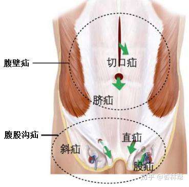 微創技術治好了腹部大洞腹腔鏡腹壁切口疝修補術