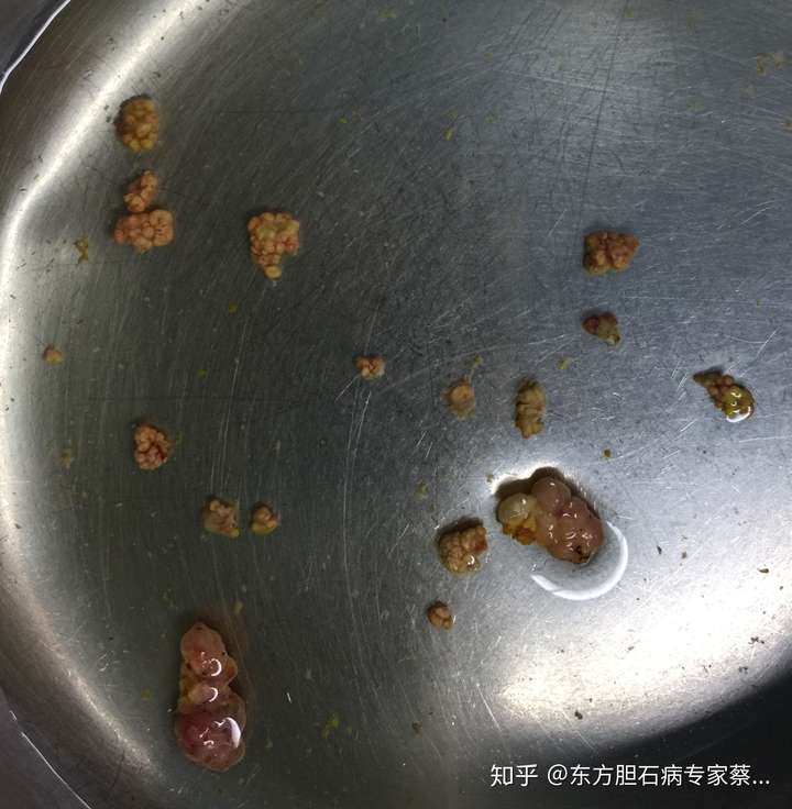 胆囊息肉3mm图片