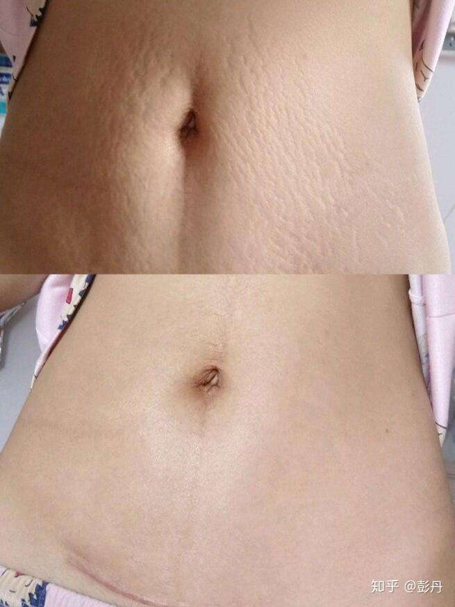 有没有生娃后妊娠纹很严重肚皮松弛的宝妈?你们会后悔难过吗?