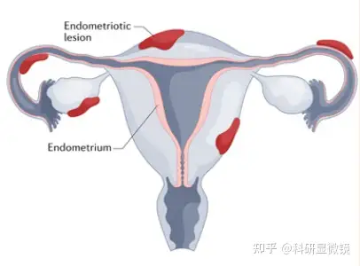 一文看懂多种子宫内膜疾病模型的优势和局限性- 知乎