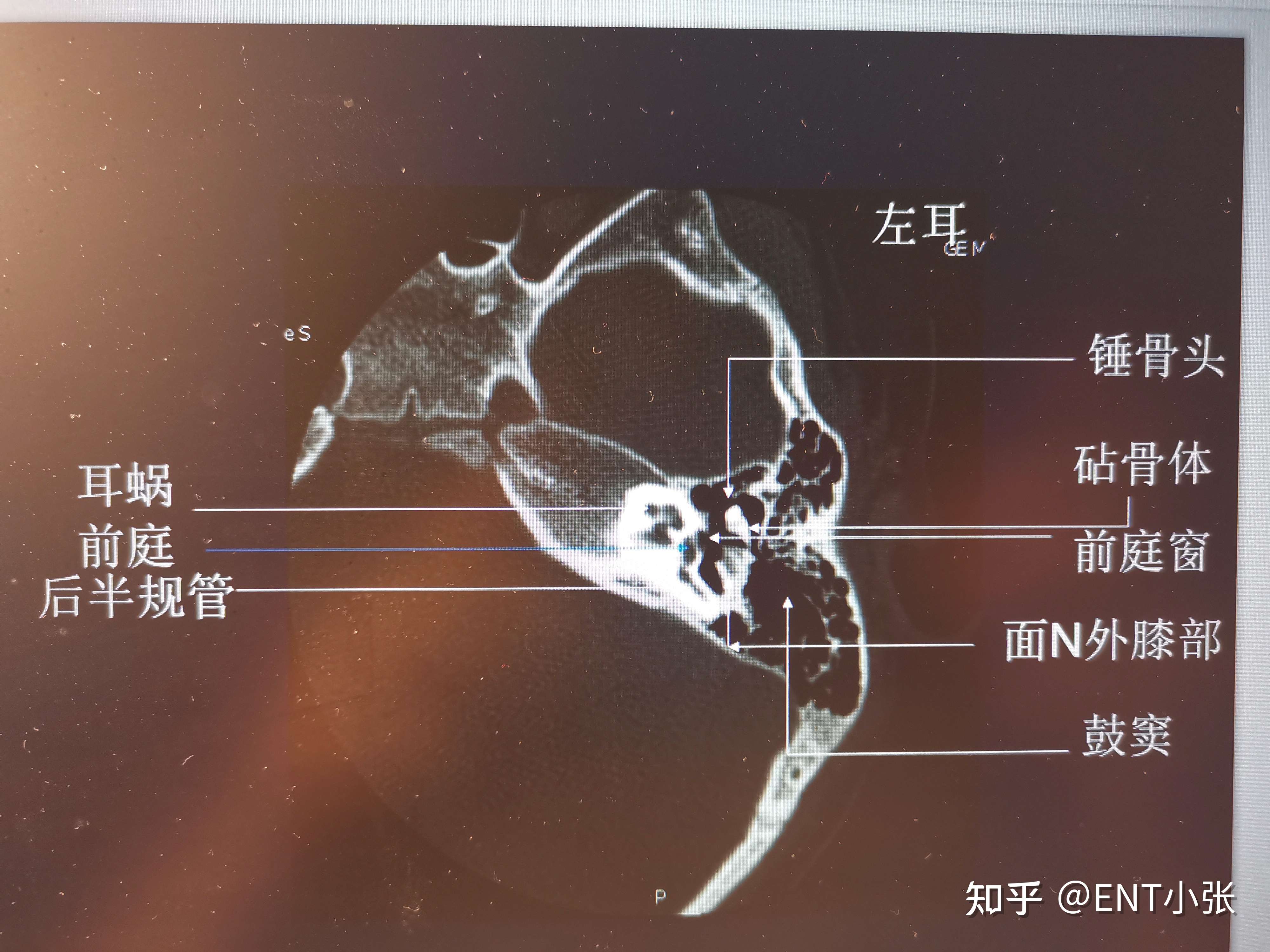 耳部ct图片