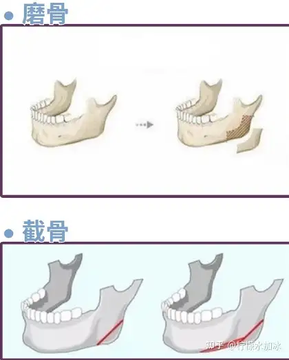 北京八大处做磨骨手术怎么样？安全吗