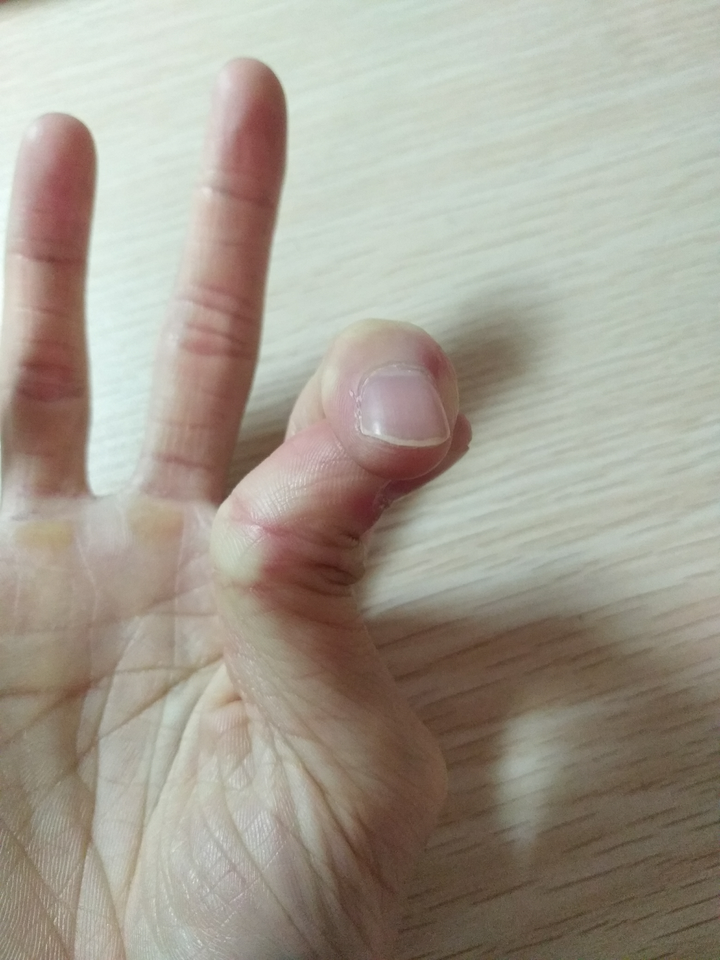 有更新 ———————————— 1,人的大拇指能背伸成这个角度的人