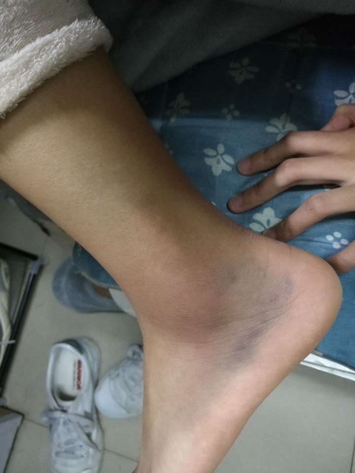 女孩子的脚受伤图片