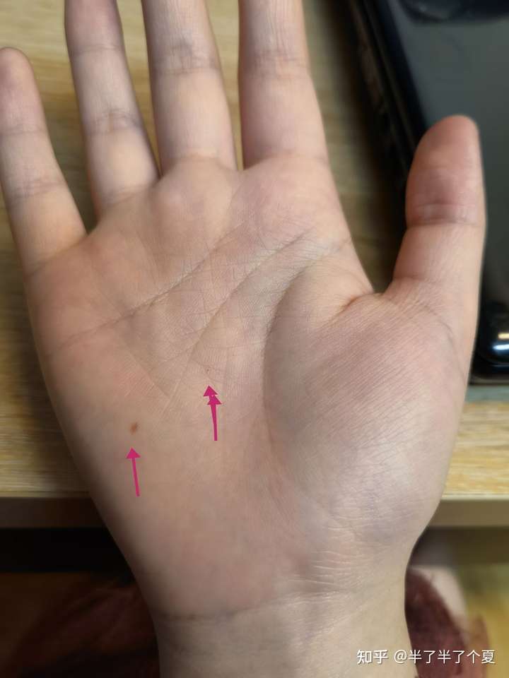 手心是红痣.我这个两个痣要求是不是有点高.
