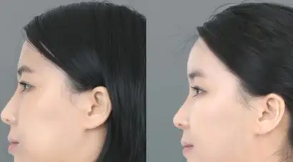 玻尿酸丰额头你知道那些 - 知乎