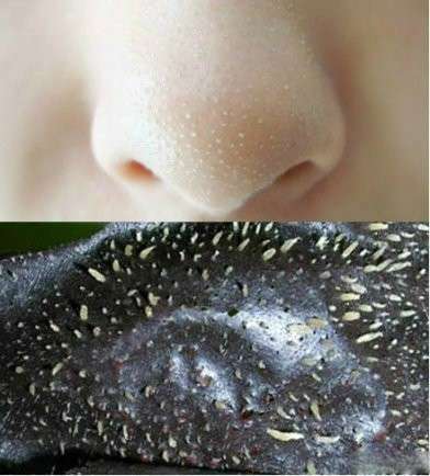 女孩子鼻子上有黑头很自卑,大家怎么处理的啊?