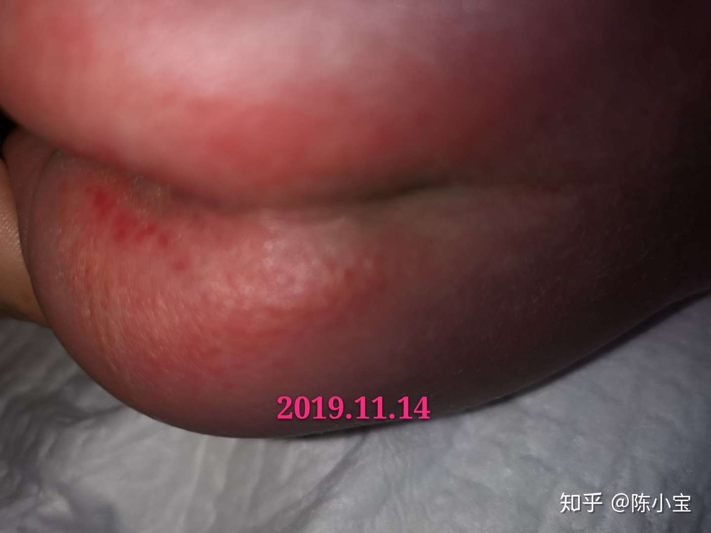 我这样护理好了宝宝得尿布疹 知乎