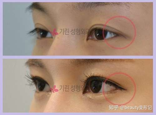 gio,绮林,伊美芝医院防止外眼角回缩的手术方法分析!