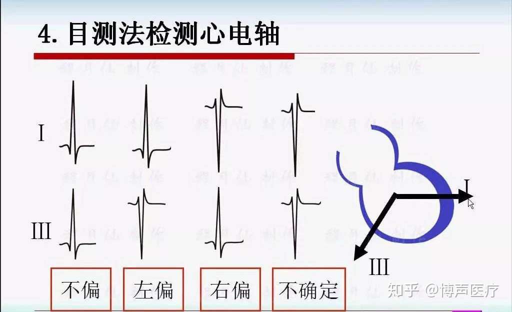 博声医疗 心电轴 心电轴右偏 知乎