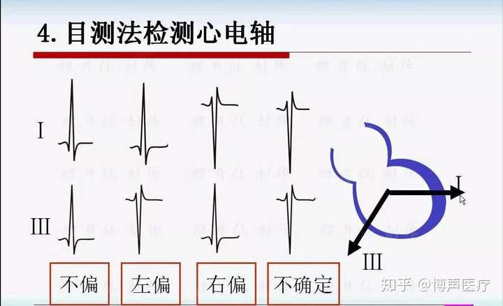心电轴目测法图片