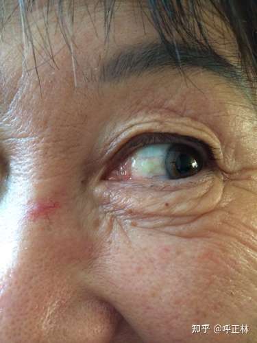白眼球上长了两个疖子还有红血丝是什么