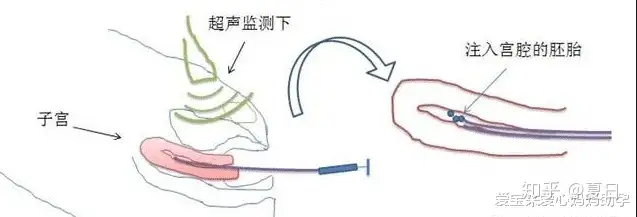 上海借卵生子（试管移植的具体步骤全解析）