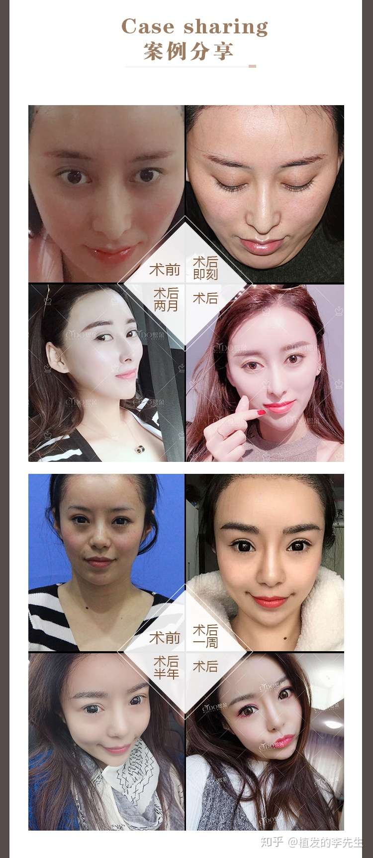 植眉毛失败如何修复 知乎 植眉毛失败如何修复 知乎