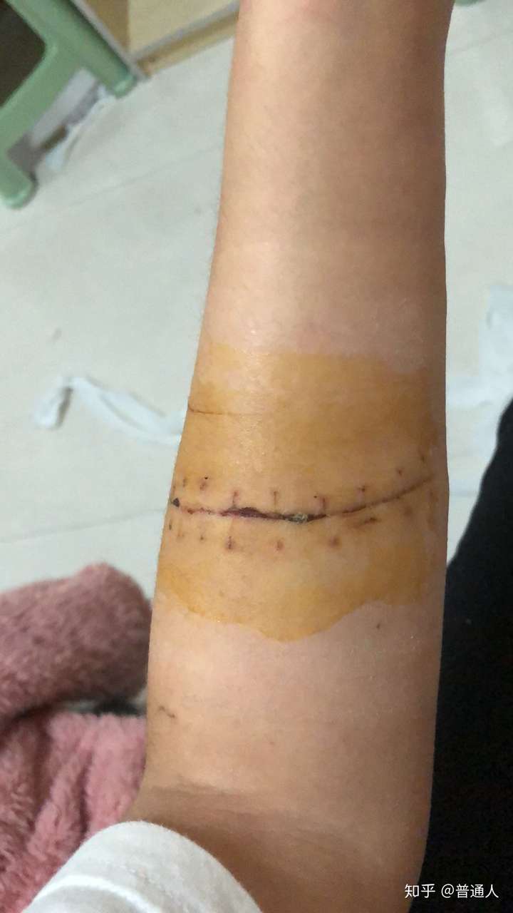 割腕的疤可以去掉吗?