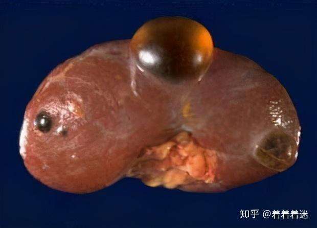 猪肾上有水泡,而人的肾上有水泡吗——男科医生李墨农