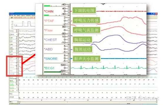 多导联睡眠呼吸监测psg解读 知乎