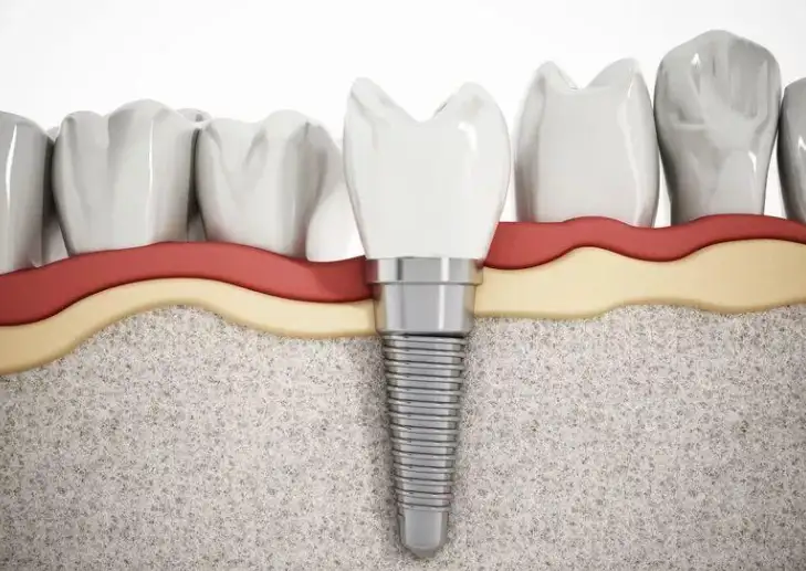 种植牙总松动是什么原因? - 知乎