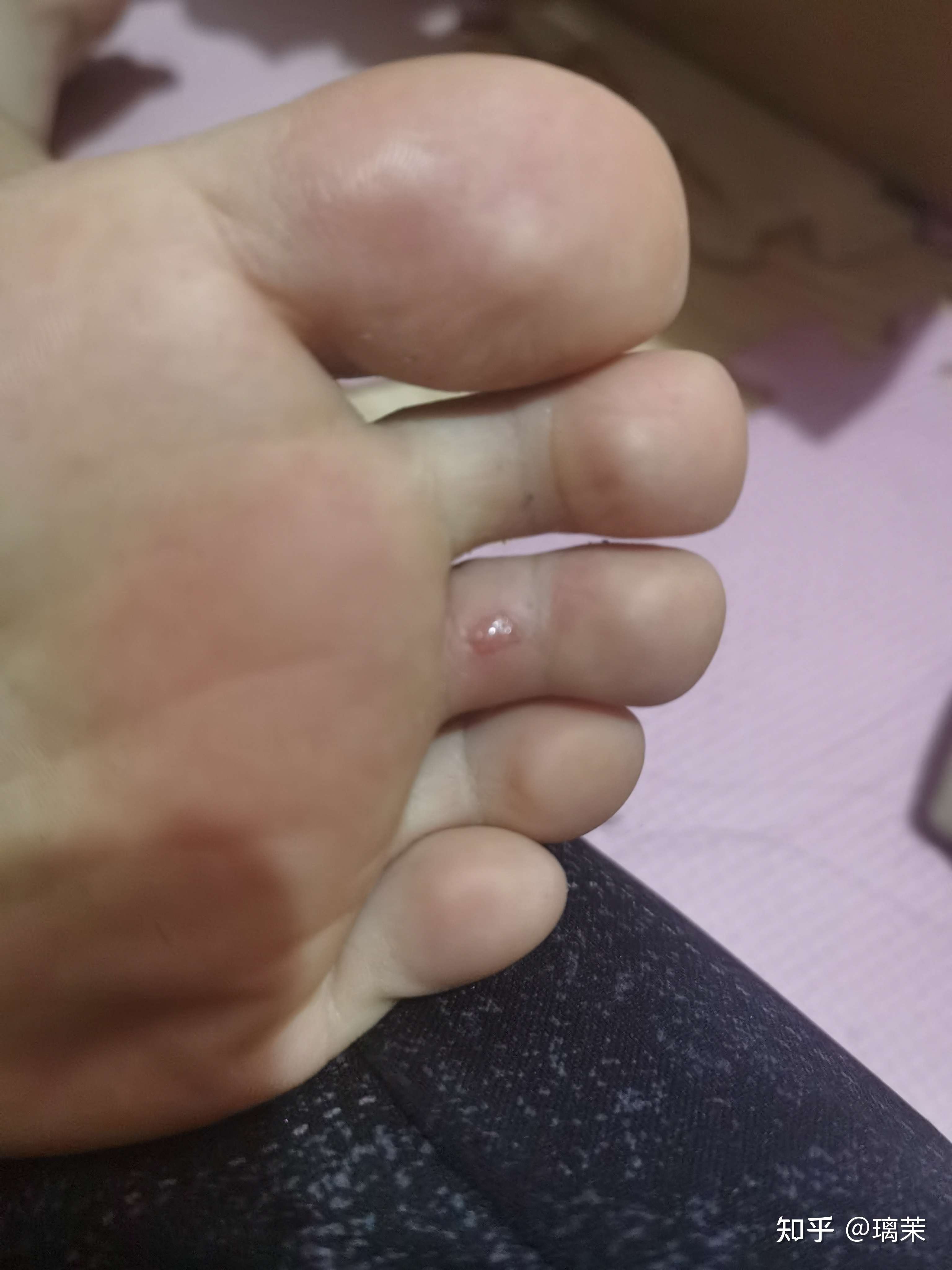 璃茉 的想法: 脚破了皮?还是怎么?要注意啥啊 - 知乎