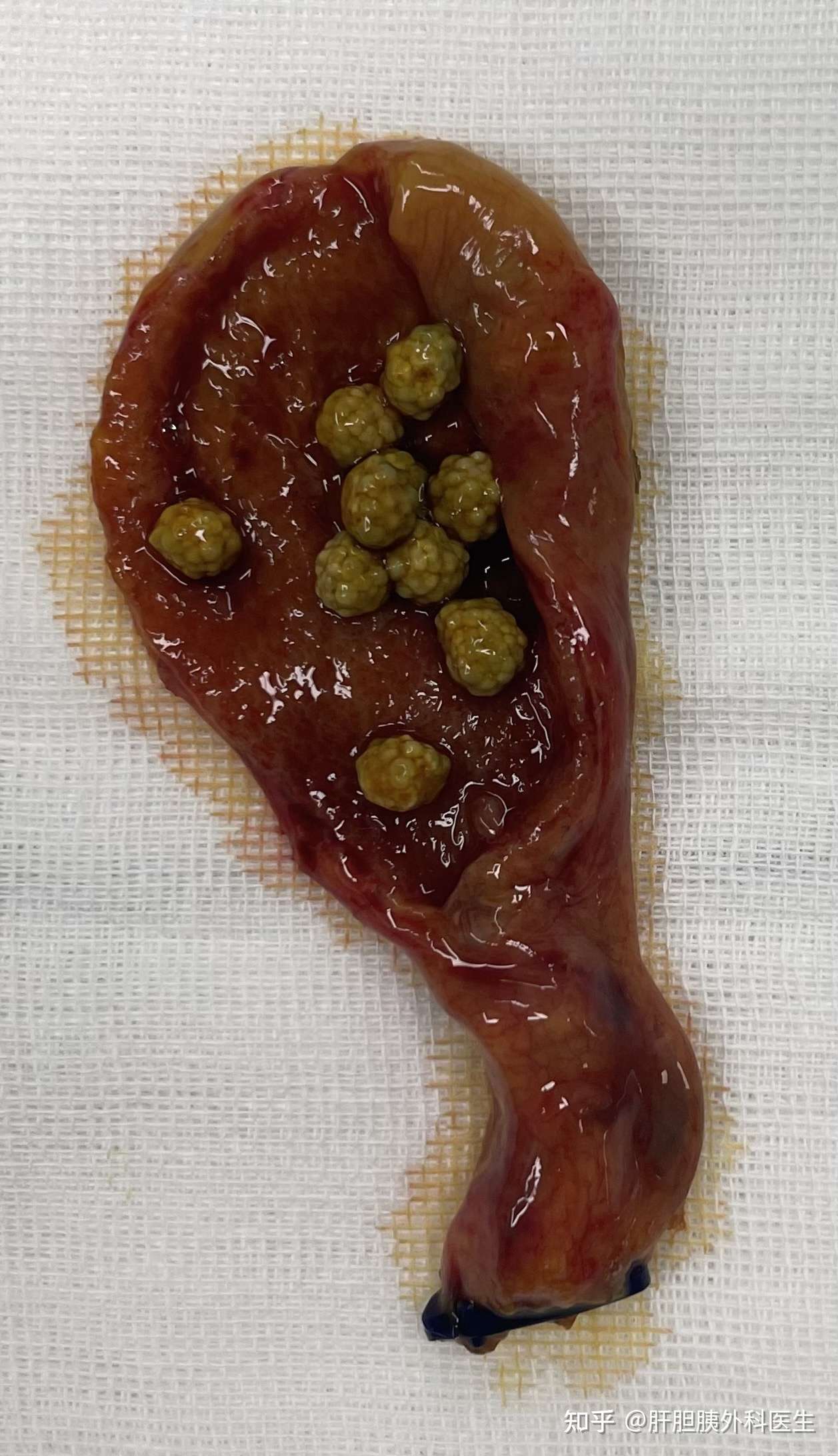 肝胆胰外科医生 的想法: 刚刚手术切除的胆囊,患者只有31岁,胆囊