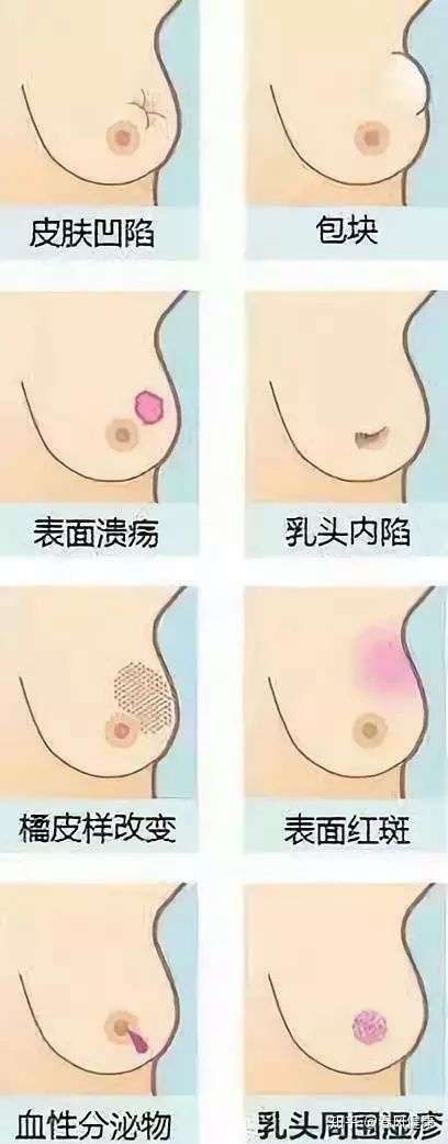 乳房疼痛 肿块是怎么回事 一定是乳腺癌吗 知乎