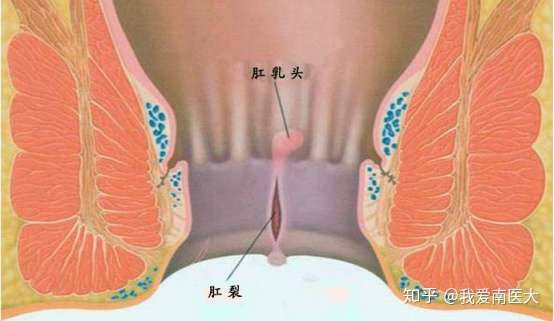 大便带血是怎么回事?还肛门还疼