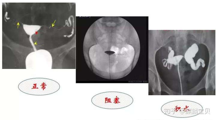 输卵管造影之后,多久可以怀孕?插图 v2-602cf5da765a8618d8099327ccc0e0f0_720w.jpg插图