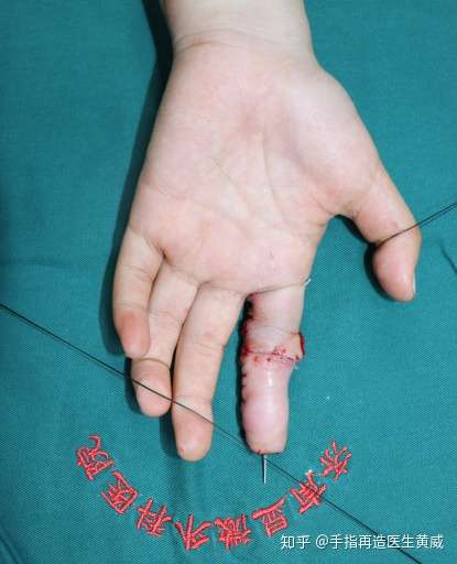 手指再造医生黄威 从事手指再造临床工作20年,专注于3d全形手指再祆