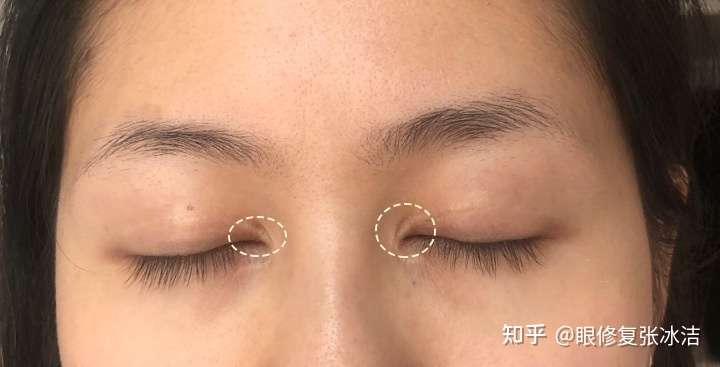 一年了眼角白色疤痕还能去除吗?
