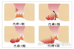 痔瘡會自己消嗎? - 知乎