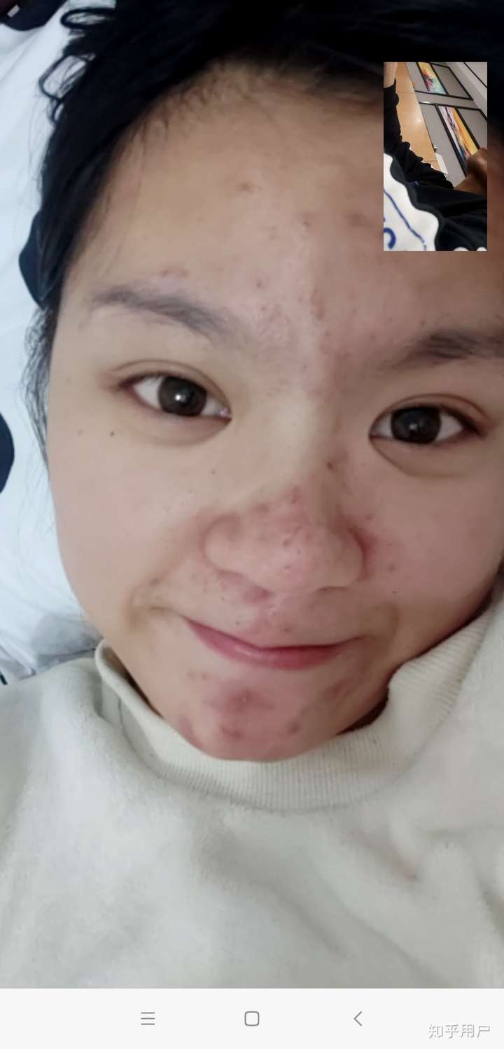 有没有长得好看但长痘痘的女生