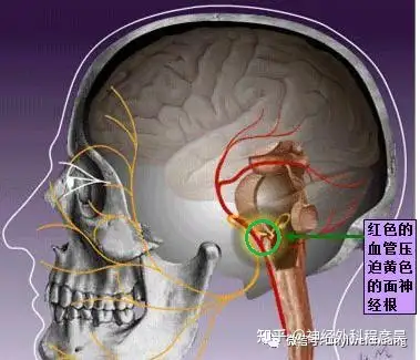 面肌痙攣主要是由於面神經根受到周圍血管的壓迫,引起