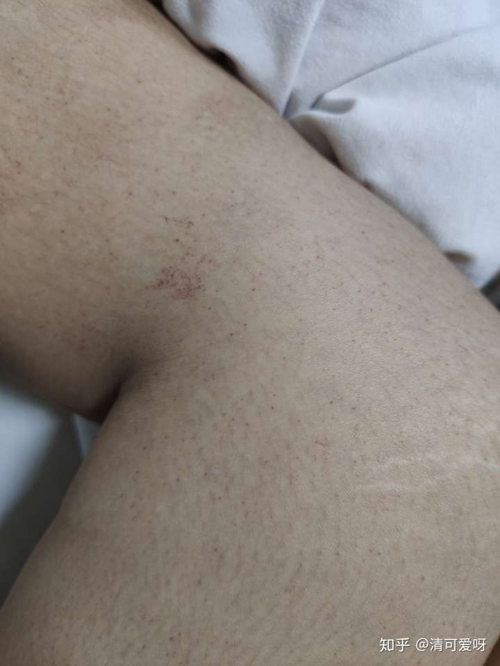 大腿上突然出现一片紫红色斑点不痛不痒是怎么了?