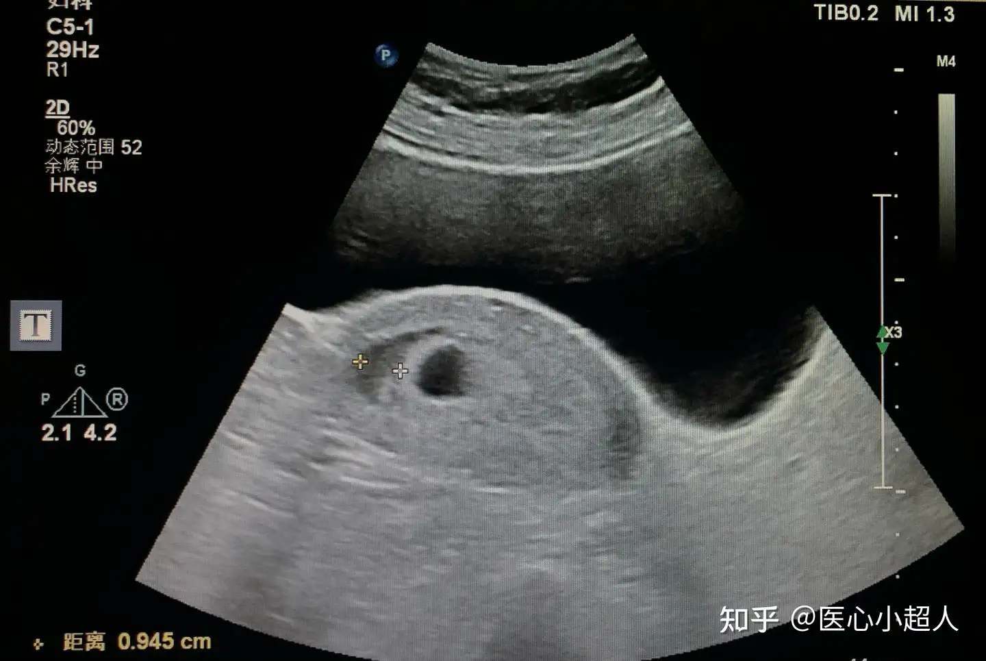 正常早期妊娠子宫超声所见 二 知乎