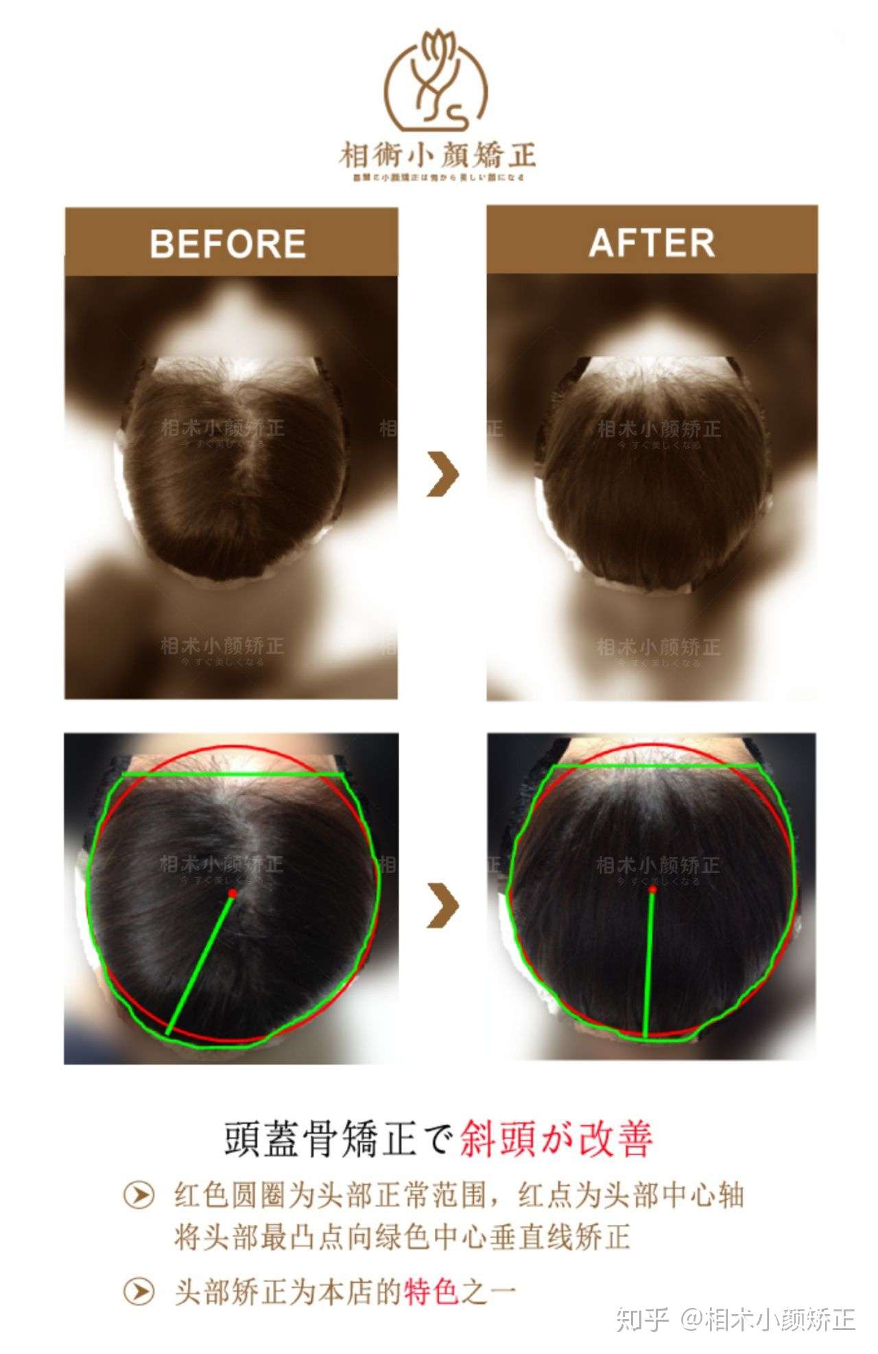 小颜矫正 歪斜头骨矫正 知乎