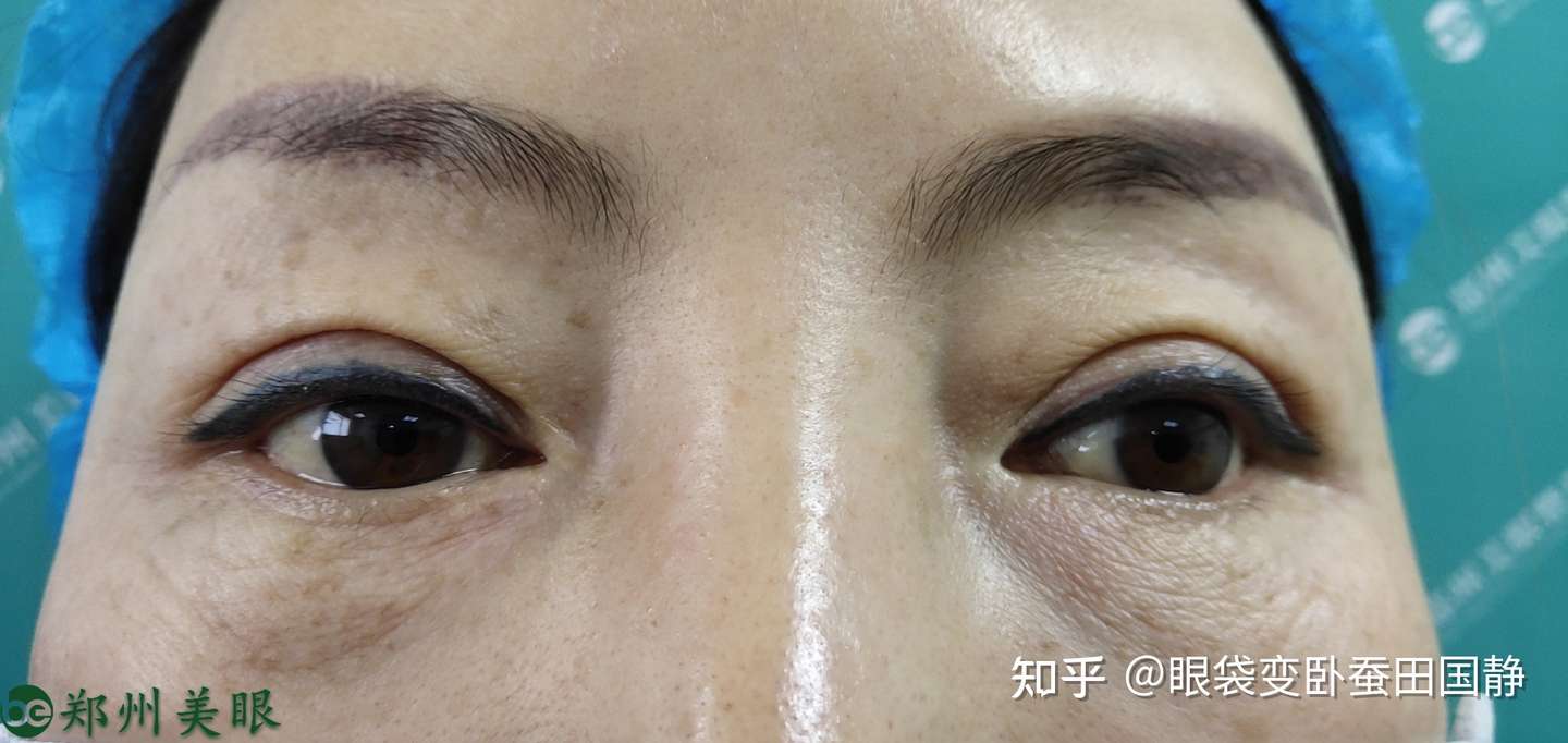 眼袋失败了该如何修复 知乎