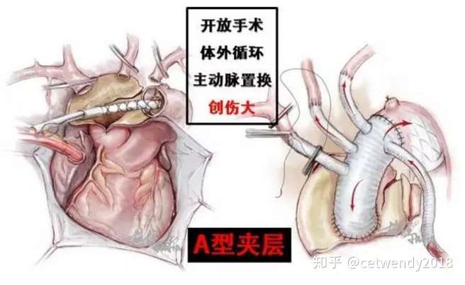 家属得了a型主动脉夹层怎么办术后费用大概多少