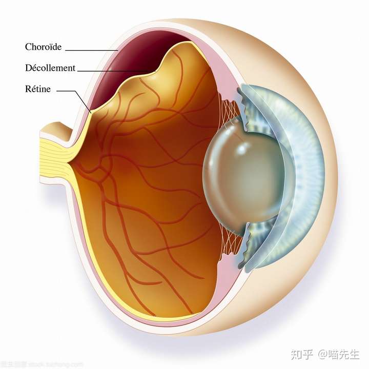 视网膜脱离的概述
