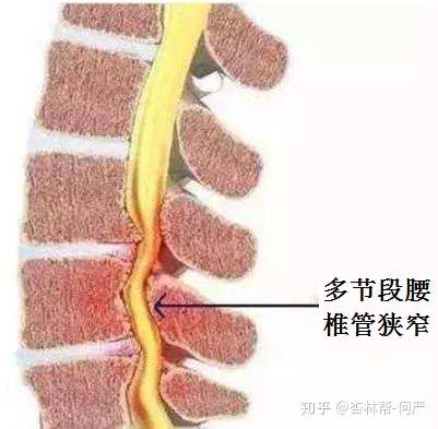 多节段腰椎管狭窄症微创手术治疗 脊柱外科专家隰建成科普系列 知乎