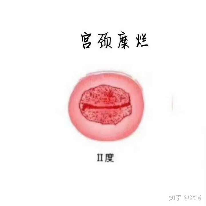 霉菌性阴炎宫颈糜烂图图片