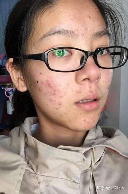 为啥突然爆痘,变油?