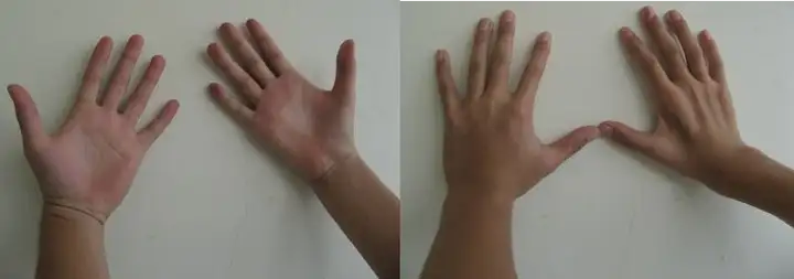 青年上肢远端肌萎缩会有哪些表现?