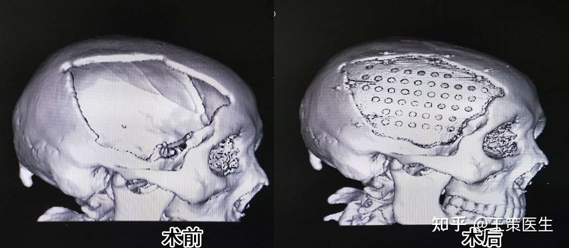 王策做颅骨修补手术时间多长 知乎