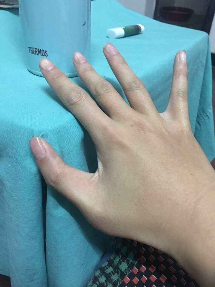 一只手有六个手指是种怎样的体验?