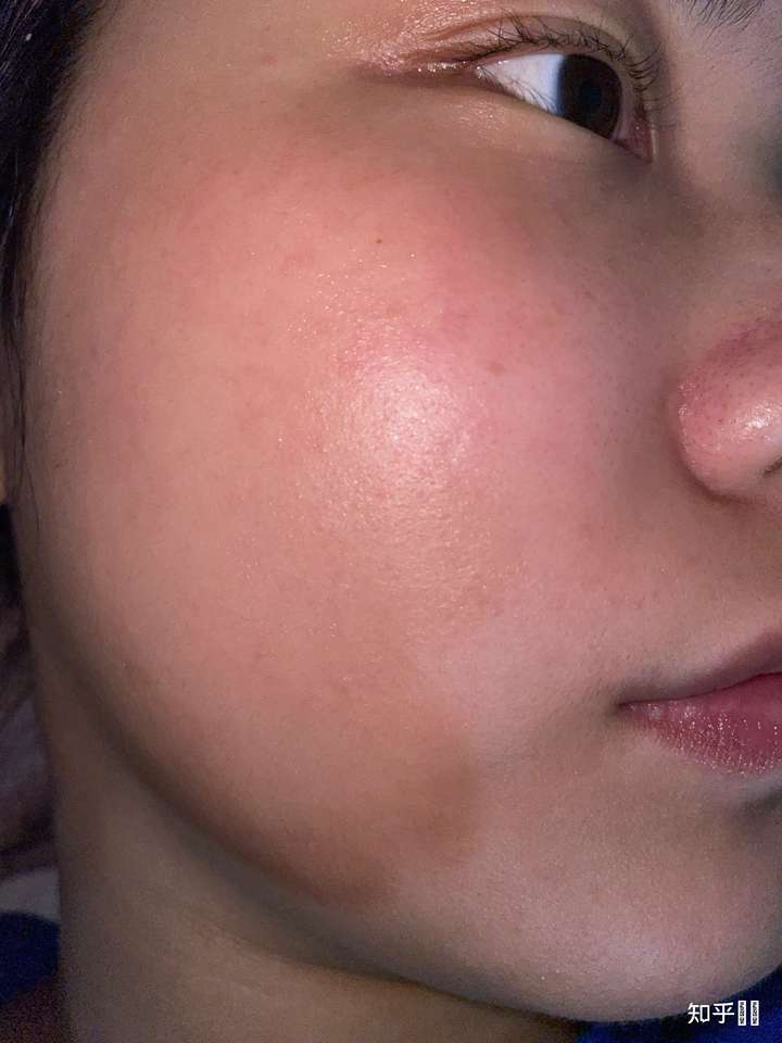 今天一照镜子吓一跳,脸颊泛红,毛孔粗大,请教各位救救孩子吧!