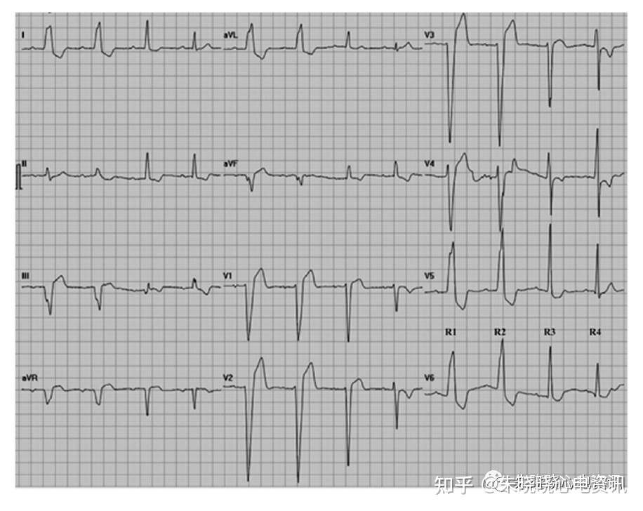 不完全性左束支阻滞的心电图诊断 知乎