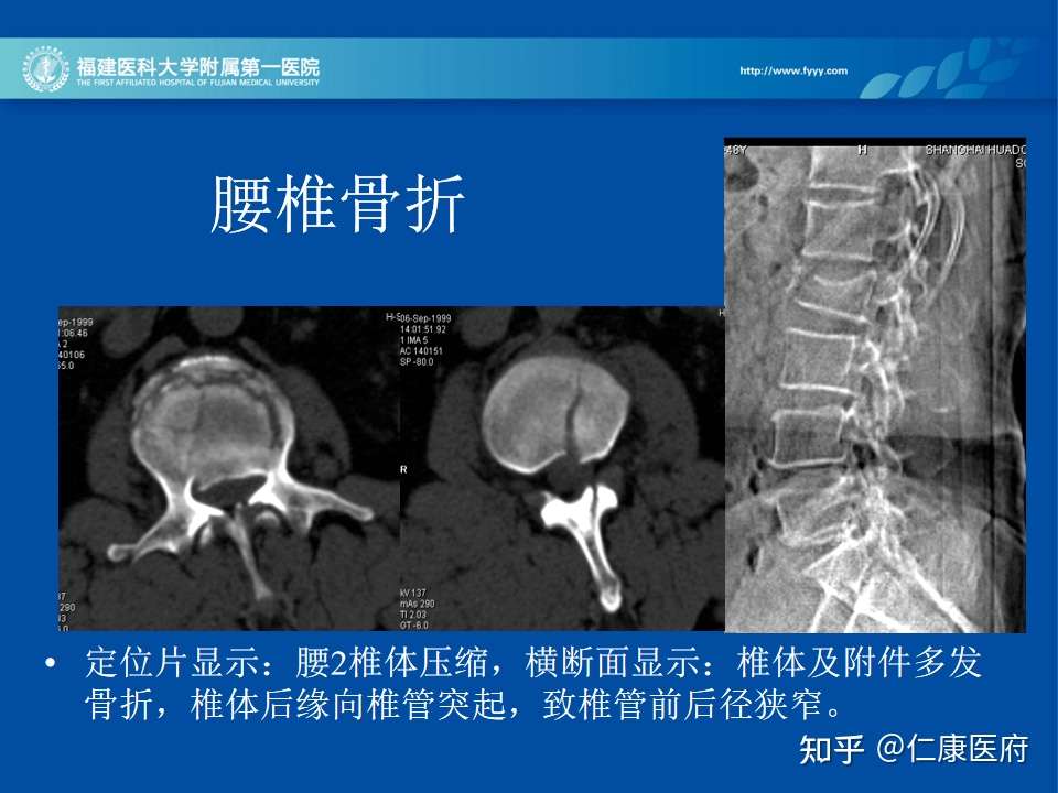 全面详解 脊柱常见病变的影像诊断 知乎