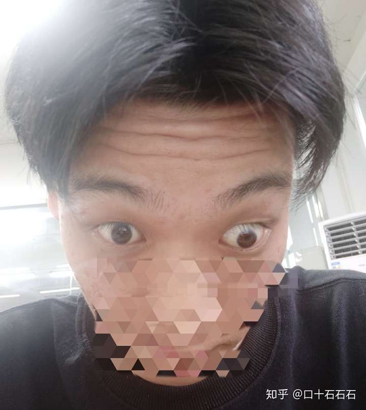 单眼失明是种怎样的体验?