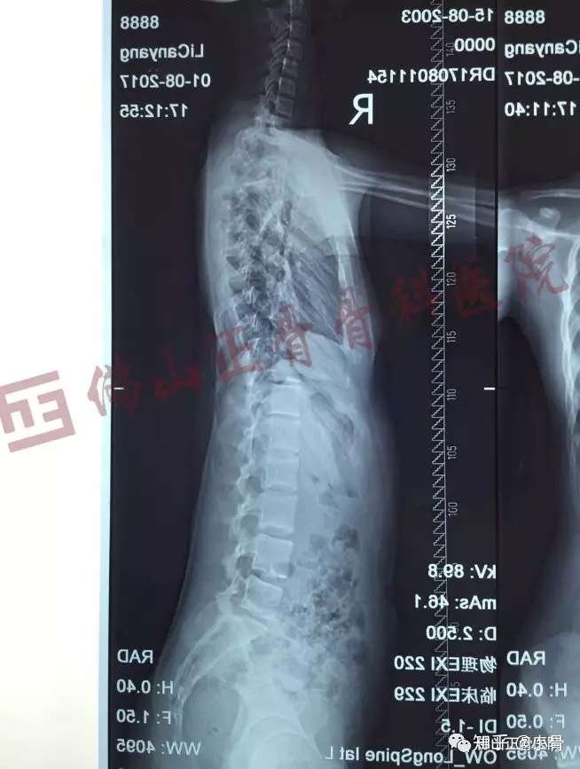 佛山专家直播预告 怎样才能及早发现青少年脊柱侧弯 5月30号下午15点约定你 知乎